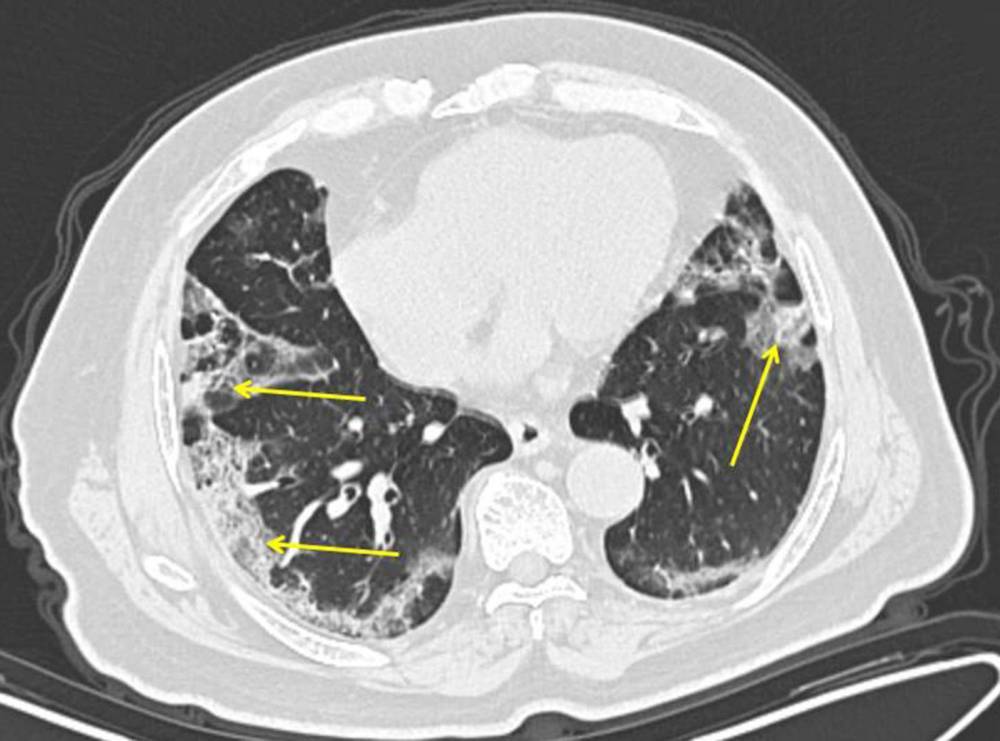 COVID-19 lung patterns show few clues for treating pneumonia - clickorlando.com - China - area District Of Columbia - Washington, area District Of Columbia