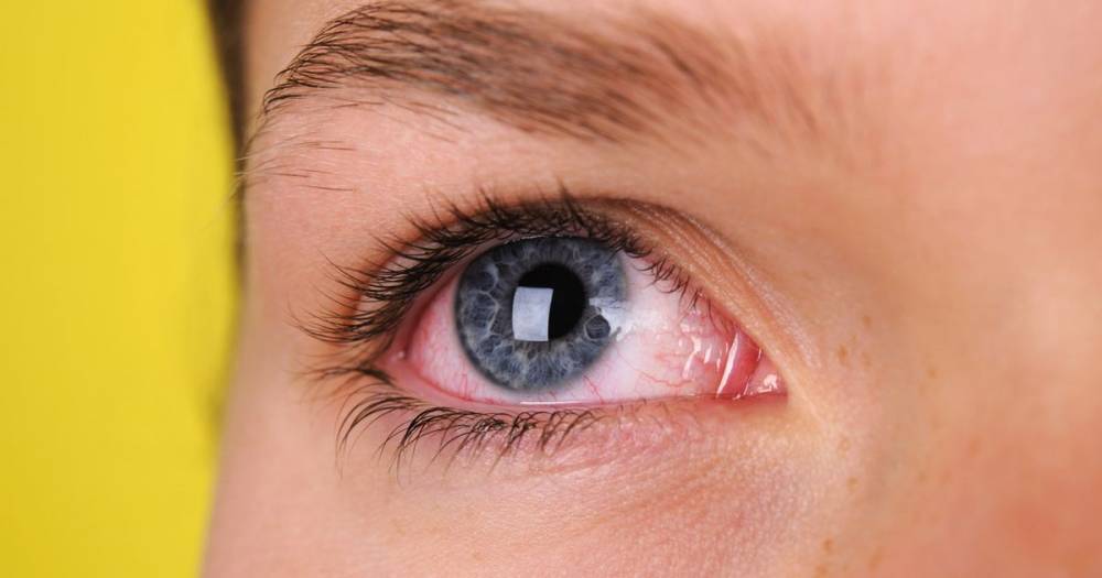 Coronavirus nurse warns red eyes are telltale sign of Covid-19 disease - dailystar.co.uk - Usa - Washington - state Washington