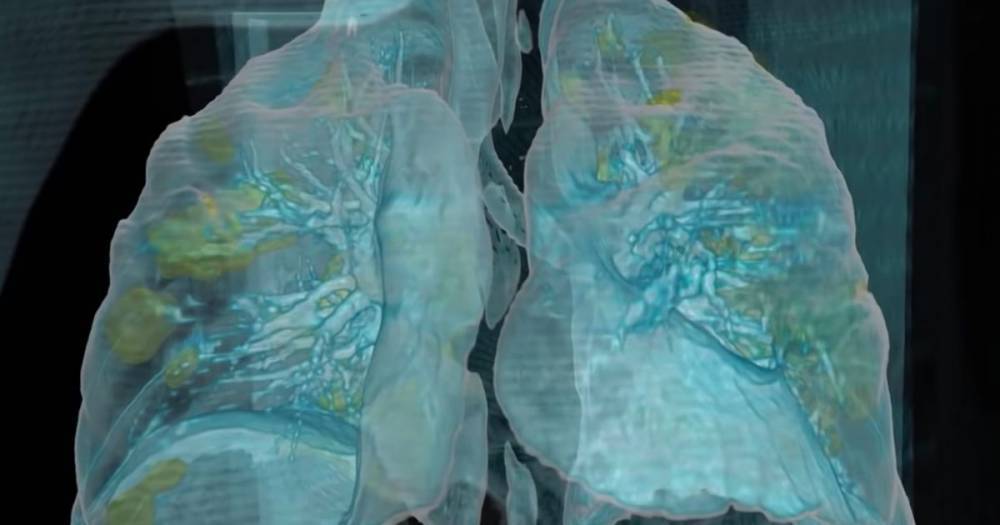 Keith Mortman - Coronavirus: Alarming VR video shows what lungs infected with COVID-19 look like - dailystar.co.uk - Usa - Washington, county George - county George - city Washington, county George