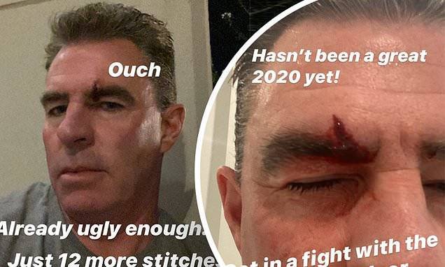 Jim Edmonds - Jim Edmonds shares grisly photos of a cut on his eyebrow that required 12 stitches - dailymail.co.uk - state California
