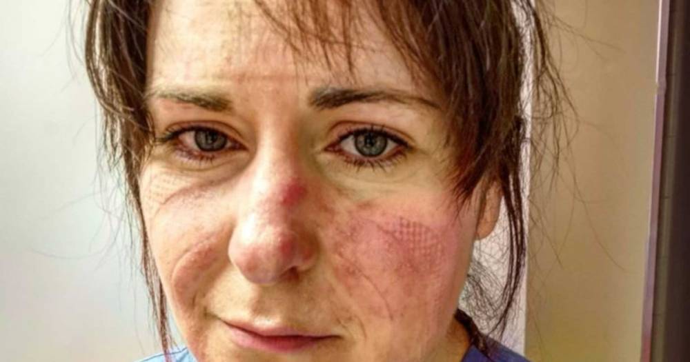 Nurse posts heartbreaking selfie of her bruised face – begging people to stay home - dailystar.co.uk