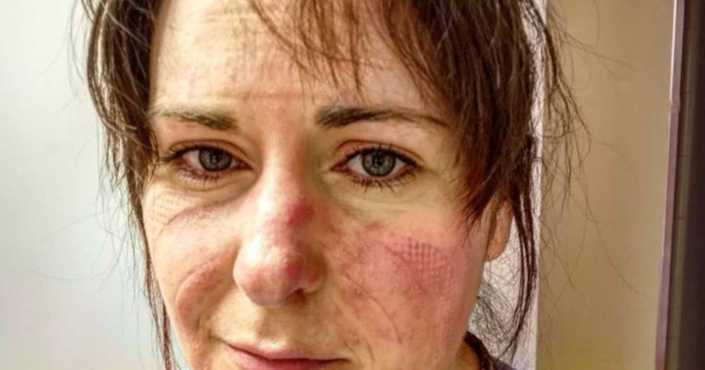 Exhausted coronavirus nurse 'going through hell' begs people to remember scarred face - mirror.co.uk