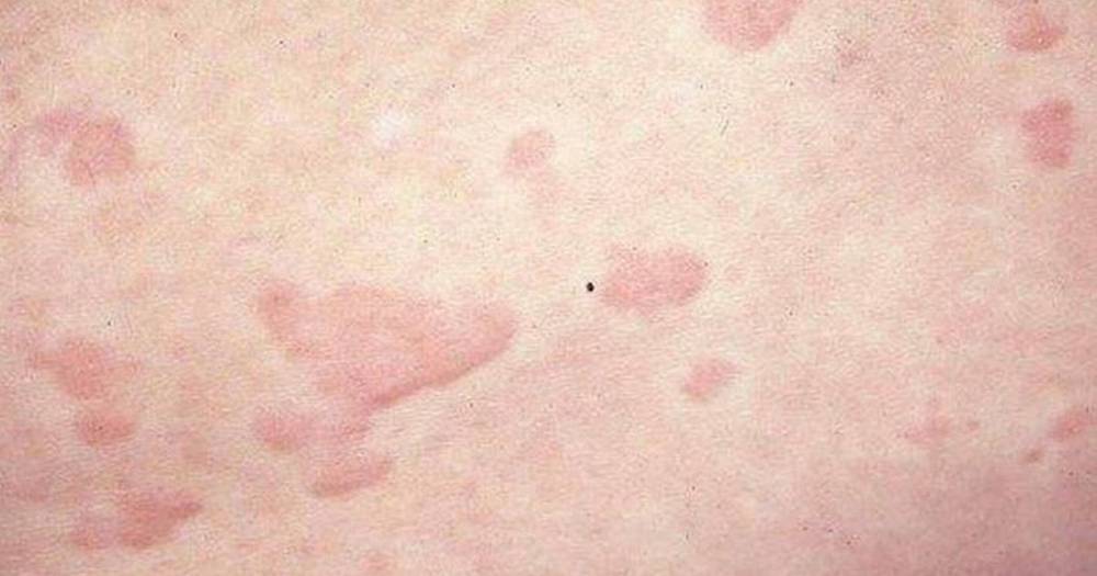 Coronavirus: Rash similar to hives and frost bite may be another telltale sign - mirror.co.uk - Spain - France