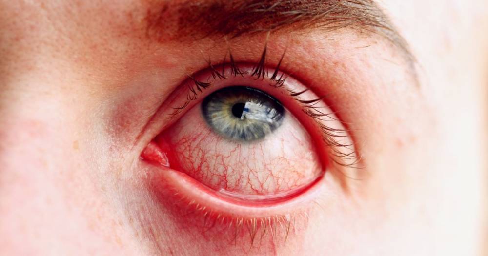 Coronavirus: Doctor says rare symptom in eyes could be early sign of infection - mirror.co.uk