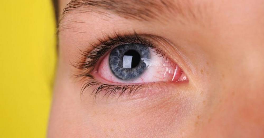Coronavirus can linger in your eyes long after symptoms disappear, study warns - mirror.co.uk - Italy