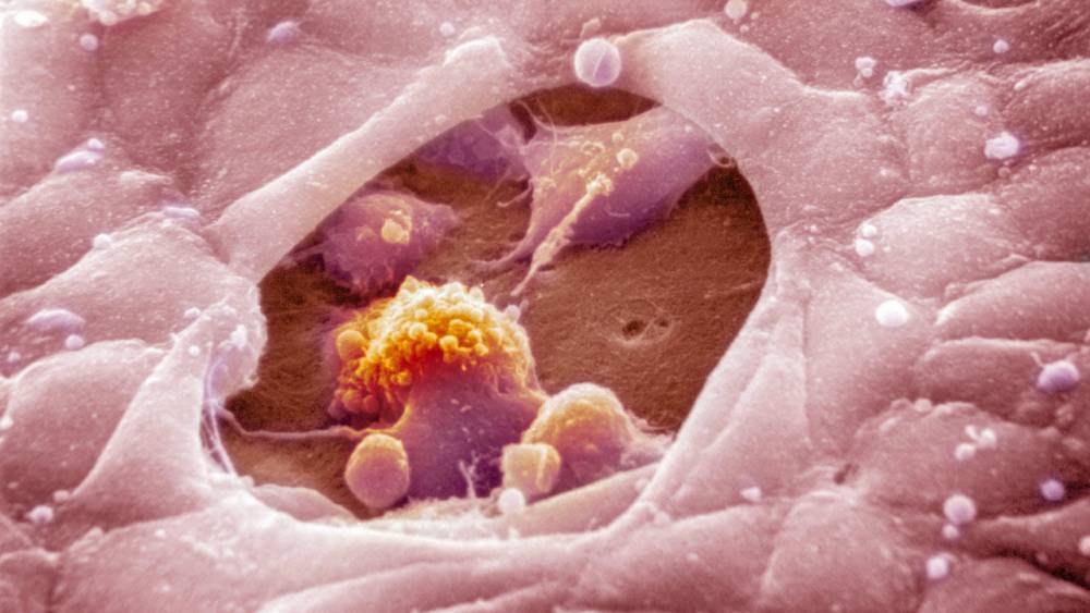 On-off dosing of cancer drugs does not help melanoma patients - sciencemag.org