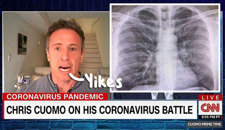 Sanjay Gupta - Chris Cuomo Shares X-Ray Showing How The Coronavirus Has Affected His Lungs — Look! - perezhilton.com