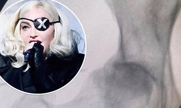 Madonna shares stem cell therapy treatment and X-rays on Instagram as she recovers from knee injury - dailymail.co.uk - France - city Paris