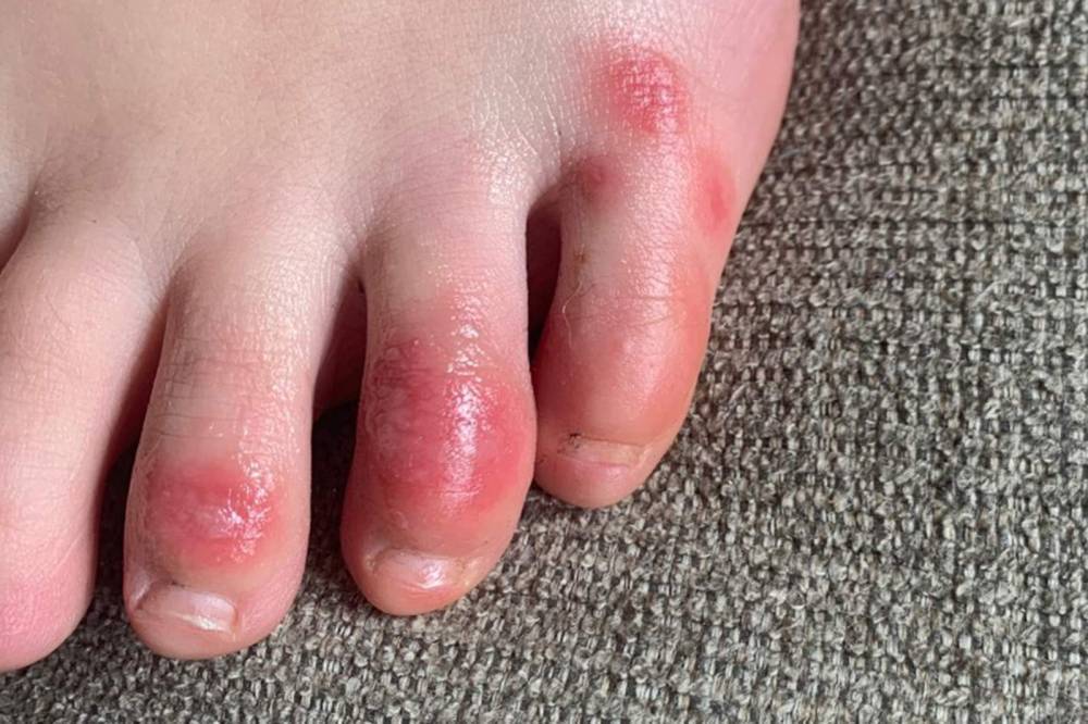 General Hospital - 'COVID toes,' other rashes latest possible rare virus signs - clickorlando.com - state Massachusets - city Boston