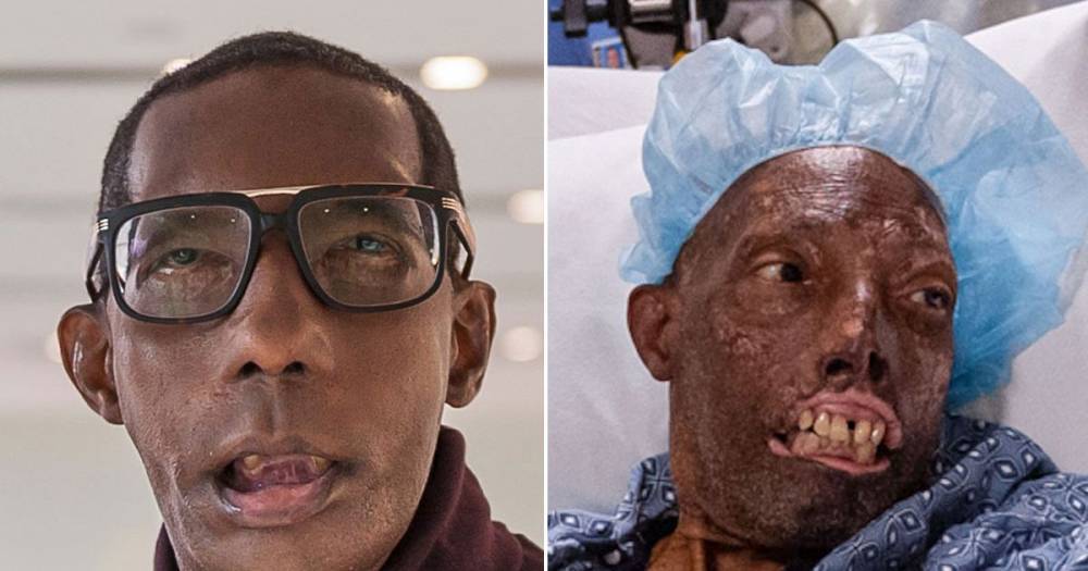 World's most amazing 'miracle' face transplants after horrific life-changing accidents - dailystar.co.uk