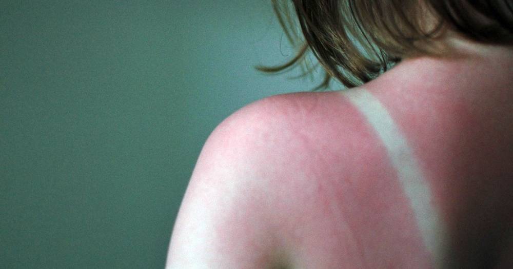 Best treatments to ease the agony of sunburn - and what you should avoid doing - mirror.co.uk - Britain