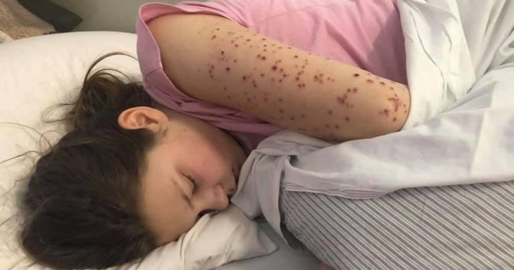 Disturbing pictures of teen, 13, battling Kawasaki-like disease caused by Covid-19 - dailystar.co.uk