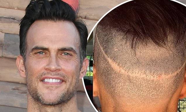 Cheyenne Jackson reveals he had FIVE hair transplants as he shows off scar from surgeries - dailymail.co.uk - Usa - county Story