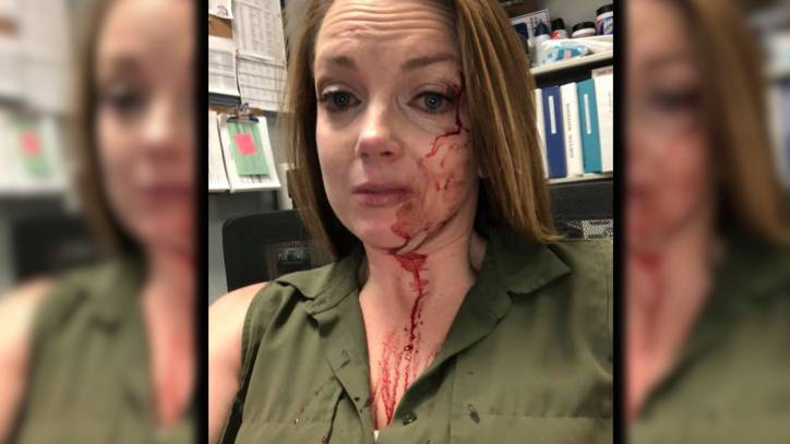 California retail employee posts photo of her bloody face after alleged customer attack - fox29.com - state California - state Indiana - city Sacramento