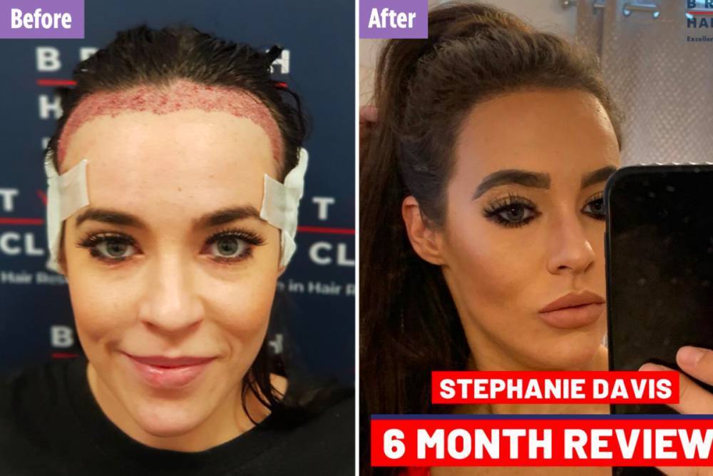 Stephanie Davis - Hollyoaks’ Stephanie Davis reveals hair transplant results to get rid of her ‘high forehead’ and lower her hairline - thesun.co.uk - Britain