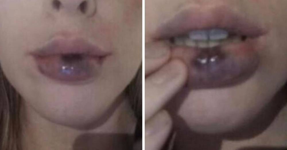 Tijion Esho - Doctor’s horror as woman attempts DIY lip fillers with disastrous consequences - ok.co.uk