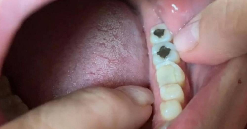 Coronavirus: Woman plugs cracked tooth and files it down in DIY lockdown filling - mirror.co.uk