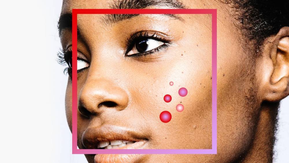 How to Get Rid of Stress Acne - glamour.com