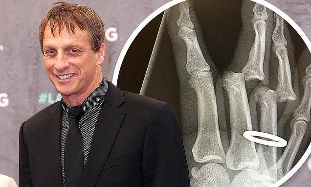 Tony Hawk had to have his wedding ring CUT OFF after injuring his hand in a skateboarding accident - dailymail.co.uk