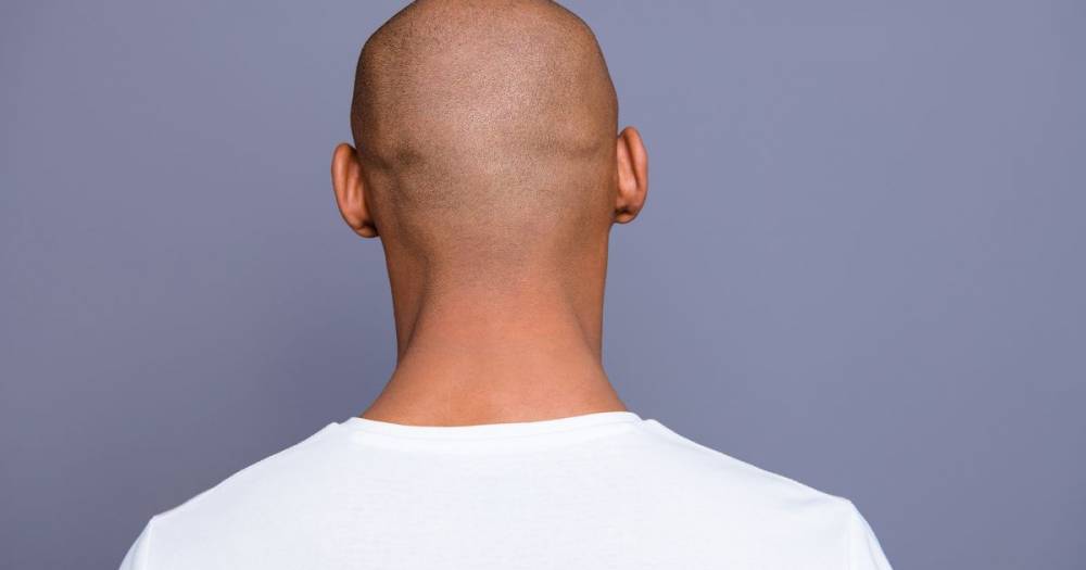 Bald men 'at greater risk' of having serious coronavirus symptoms study claims - mirror.co.uk - Spain