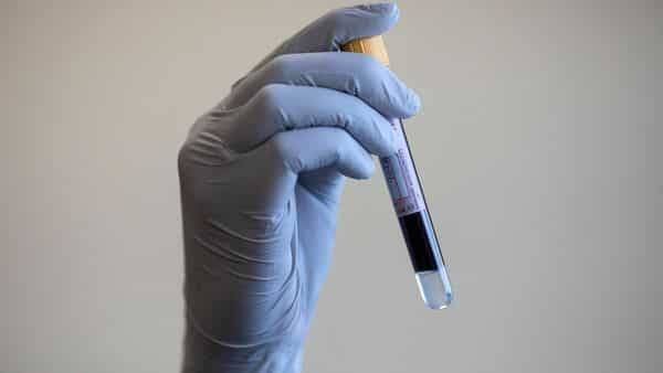 Scientists spot differences in blood samples of severe, mild Covid-19 patients - livemint.com - Britain - city Cambridge