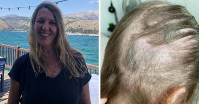 Coronavirus survivor suffers devastating hair loss as experts warn post-Covid shedding is rife - ok.co.uk