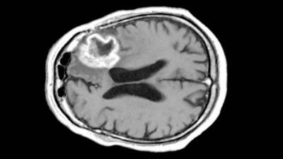 Study of 111 ‘exceptional’ cancer patients yields clues to better drug treatments - sciencemag.org