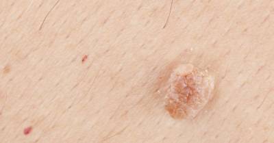 Can you remove a skin tag yourself? - medicalnewstoday.com
