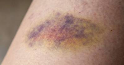 What to know about bruising easily - medicalnewstoday.com