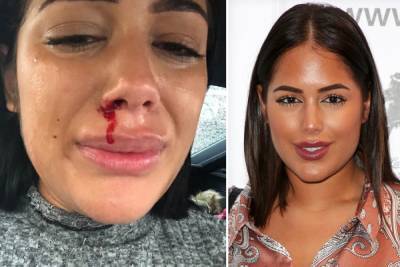 Malin Andersson - Love Island’s Malin Andersson shares harrowing photo of bloody nose and tears as she warns about domestic abuse - thesun.co.uk
