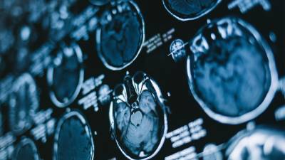 $21.8 million for research into neurological disorders - health.gov.au