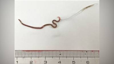 Doctors find worm in woman’s tonsil 5 days after she ate sashimi - fox29.com - Usa