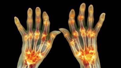 Newly identified cell type may help predict, treat rheumatoid arthritis flares - sciencemag.org