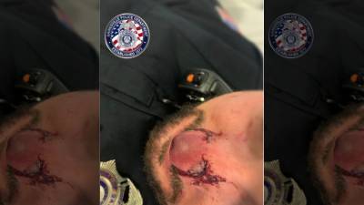 Police: Suspect in drug-related arrest bit officer's nose while trying to escape - fox29.com - county Hall