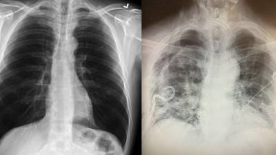 Texas surgeon noticing some post-COVID lungs have more scar tissue than smokers’ lungs - fox29.com - state Texas - county Lubbock