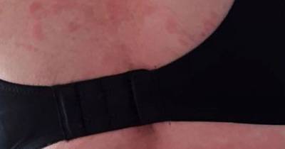 Mum who claims she got Covid twice developed 'torturous rash' and still suffers - mirror.co.uk