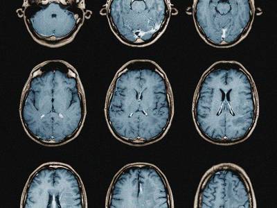 Study finds new evidence of SARS-CoV-2 damaging brain blood vessels - medicalnewstoday.com