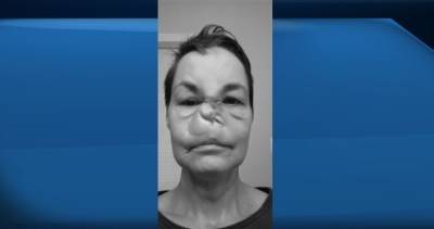 COVID-19: Saskatchewan woman who was scared after Alberta surgery cancelled says it’s back on - globalnews.ca