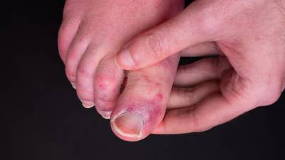 'Covid toes' could be side effect of immune system's response to virus - study - rte.ie - Britain