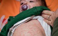 WHO, CDC warn COVID disruptions could stall measles battle - cidrap.umn.edu - Usa - region European