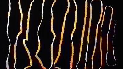 Man hospitalized with seizures discovers tapeworm was in brain for decades - fox29.com - state Massachusets - Guatemala