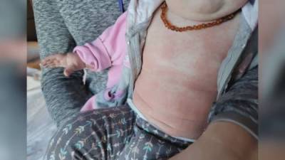 Jules Knox - Baby develops severe rash after pool swim at Kelowna hotel - globalnews.ca
