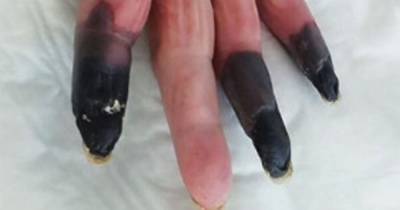 Covid patient's fingers turn black with gangrene in shocking new 'severe manifestation' of virus - dailystar.co.uk - Italy