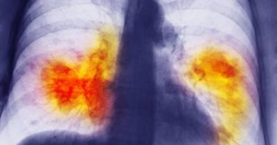Doctors warning as lung cancer cases ‘missed due to pandemic delays’ - manchestereveningnews.co.uk - Britain - city Manchester