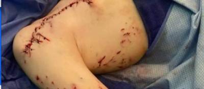 ‘A shark tried to eat me:’ 9-year-old boy recovering after bite at Florida beach - clickorlando.com - state Florida - state Minnesota