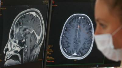 Extended brain fog may be a common symptom after COVID-19 infection, according to study - fox29.com - state California - San Francisco - city San Francisco, state California