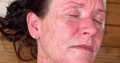 Mum's face and body erupt in agonising rash after getting AstraZeneca Covid jab - dailystar.co.uk - Britain - Scotland