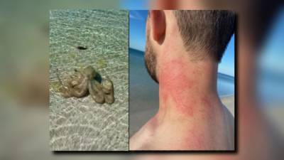 Man finds ‘the angriest octopus’ on Australian beach, later attacked while swimming - fox29.com - Australia - county Bay