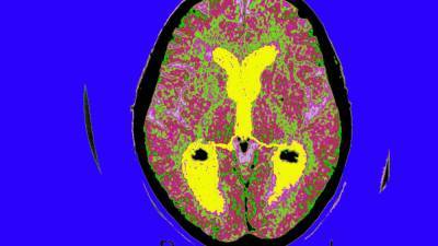 Does new Alzheimer's drug work? It may take 9 years to find out - fox29.com