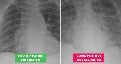 Alarming X-rays show lung damage difference between vaxxed and unvaxxed Covid patients - dailystar.co.uk - state Missouri - county St. Louis